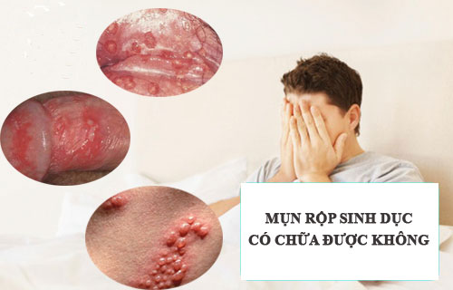 Mụn rộp sinh dục có chữa được không?
