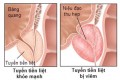 Viêm tuyến tiền liệt: Nguyên nhân, dấu hiệu và cách chữa
